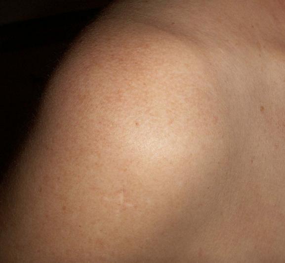 Arthroscopy and the painful shoulder Total Health